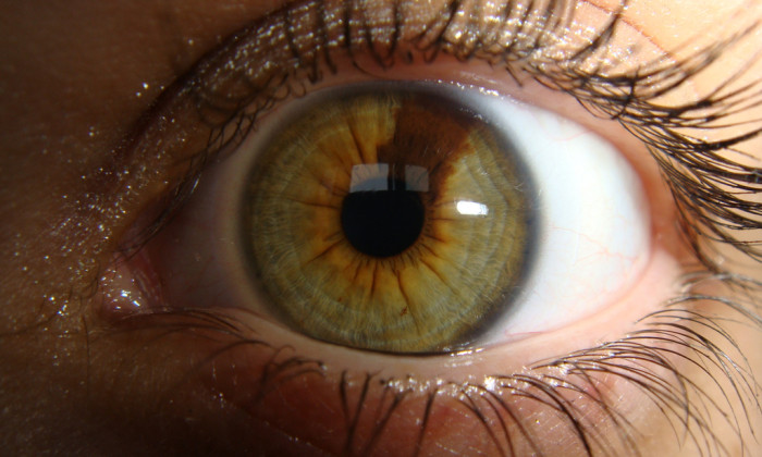 PartialHeterochromia